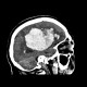 Brain hemorrhage, hypertonic, hemocephalus: CT - Computed tomography